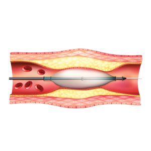 Angioplasty Treatment in Vijayawada