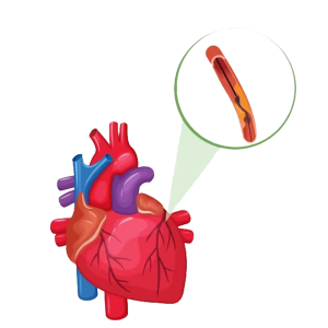 Coronary Angiogram Treatment
