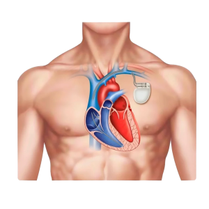 Permanent Pacemaker